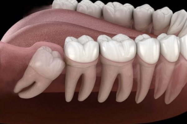 Perché i denti anteriori si spostano con il tempo? Sfatiamo un mito