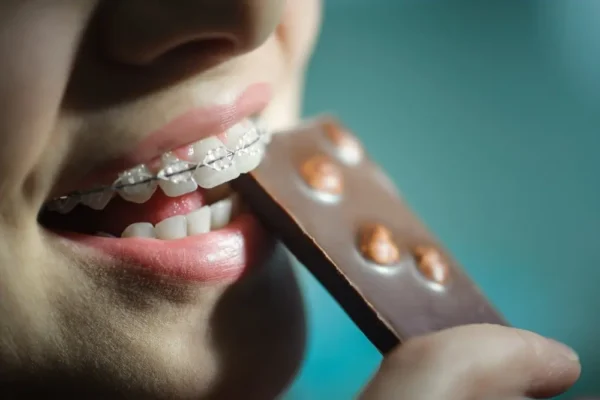 Alimenti vietati con l’apparecchio: cosa non mangiare durante il trattamento