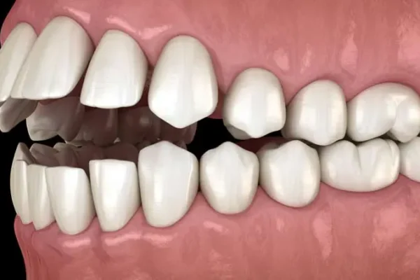 Morso aperto: sintomi, rischi e trattamenti