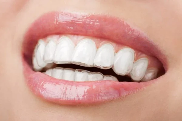 Invisalign: cosa succede se salto 1 giorno?